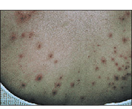 Describe las características, patogenicidad, vías de transmisión y prevención. Staphylococcus y Streptococcus.