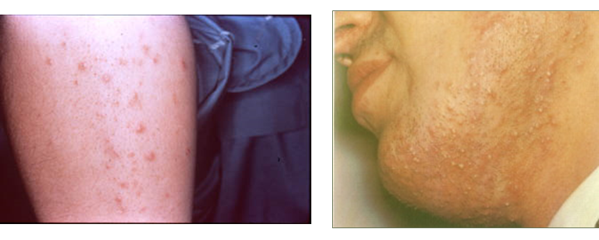 Describe las características, patogenicidad, vías de transmisión y prevención. Staphylococcus y Streptococcus.