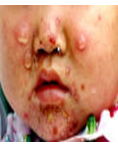 Describe las características, patogenicidad, vías de transmisión y prevención. Staphylococcus y Streptococcus.
