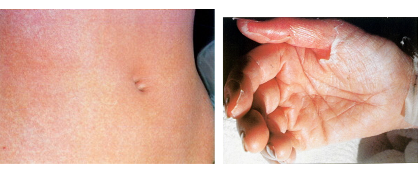 Describe las características, patogenicidad, vías de transmisión y prevención. Staphylococcus y Streptococcus.